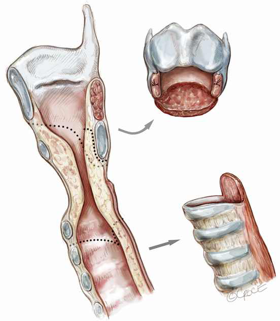 Idiopathic subglottic stenosis techniques and results Axtell Annals