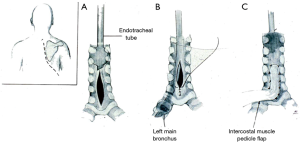 Management of laryngotracheal trauma - Moonsamy- Annals of ...