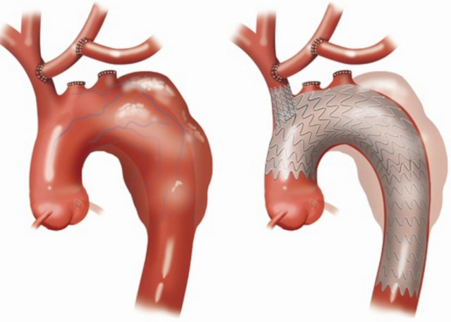 Double transposition and single branched TEVAR for total arch