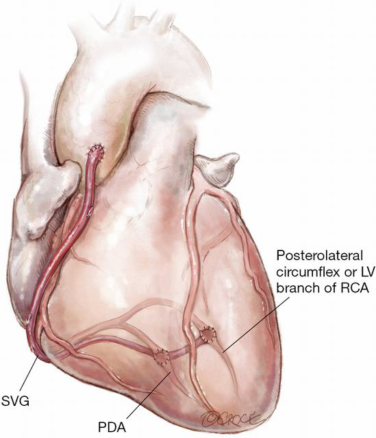 Download How I Deploy Arterial Grafts Taggart Annals Of Cardiothoracic Surgery