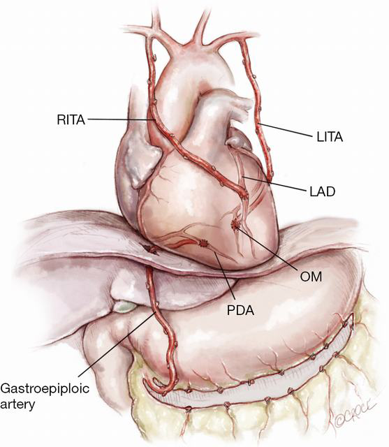How I Deploy Arterial Grafts Taggart Annals Of Cardiothoracic Surgery