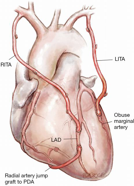 Download How I Deploy Arterial Grafts Taggart Annals Of Cardiothoracic Surgery