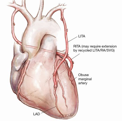 Download How I Deploy Arterial Grafts Taggart Annals Of Cardiothoracic Surgery