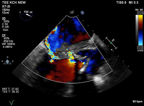 Multiple valve endocarditis: a Hemi-Commando procedure - Vojacek ...