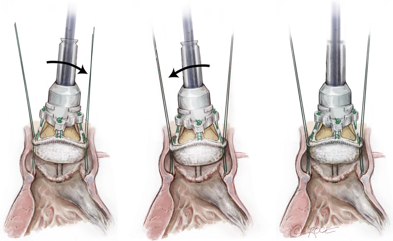 Sutureless And Rapid Deployment Valves Implantation Technique From A To Z—the Intuity Elite 