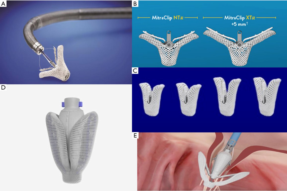 Over 15 Years The Advancement Of Transcatheter Mitral Valve Repair