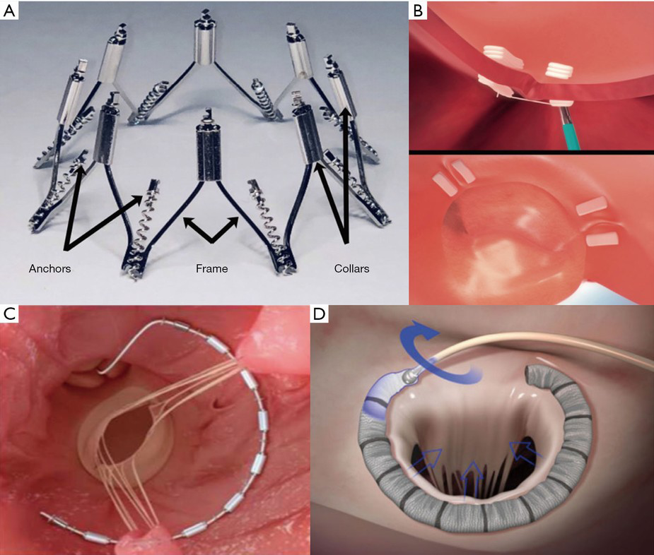 Over 15 Years The Advancement Of Transcatheter Mitral Valve Repair