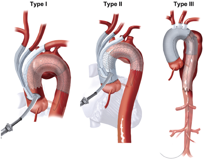 what is the mortality rate for ascending aorta repair