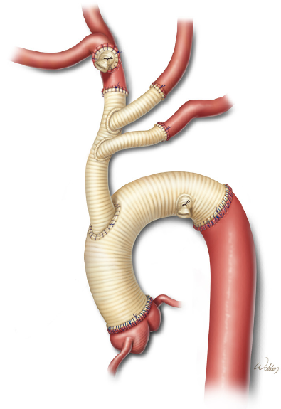 Total aortic arch replacement: current approach using the trifurcated ...