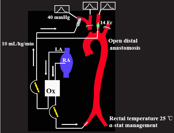 Total arch replacement with separated graft technique and selective