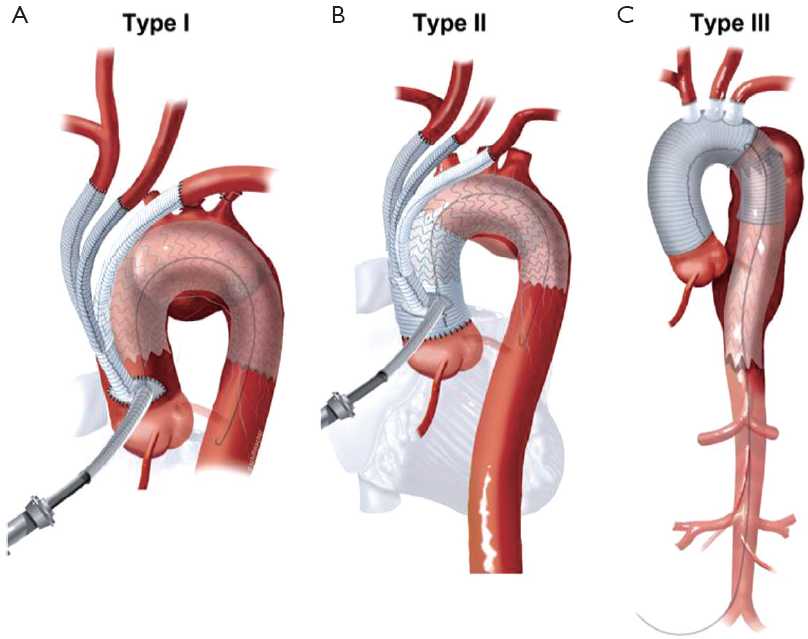 surgical treatment for ascending aortic aneurysm