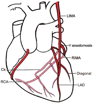 internal thoracic artery