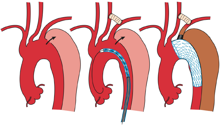 Best Surgical Option For Arch Extension Of Type B Dissection The Endovascular Approach Kuratani Annals Of Cardiothoracic Surgery Should you get surgery for your shoulder labral tear? type b dissection