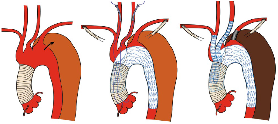 Best Surgical Option For Arch Extension Of Type B Dissection The Endovascular Approach Kuratani Annals Of Cardiothoracic Surgery Tevar is a minimally invasive surgery. type b dissection