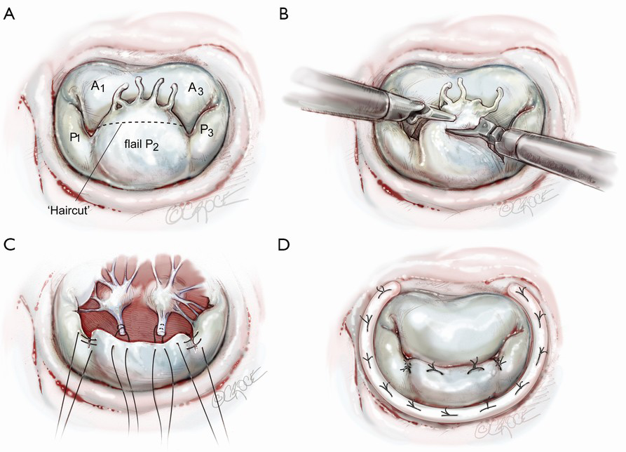 Haircut Mitral Valve Repair Posterior Leaflet Plasty Chitwood Jr