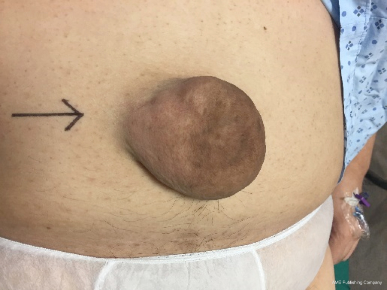 Umbilical Hernia When And How Maia Annals Of Laparoscopic And Endoscopic Surgery This video demonstrate laparoscoic repair of umbilical hernia by dr r k mishra at world laparoscopy hospital. umbilical hernia when and how maia