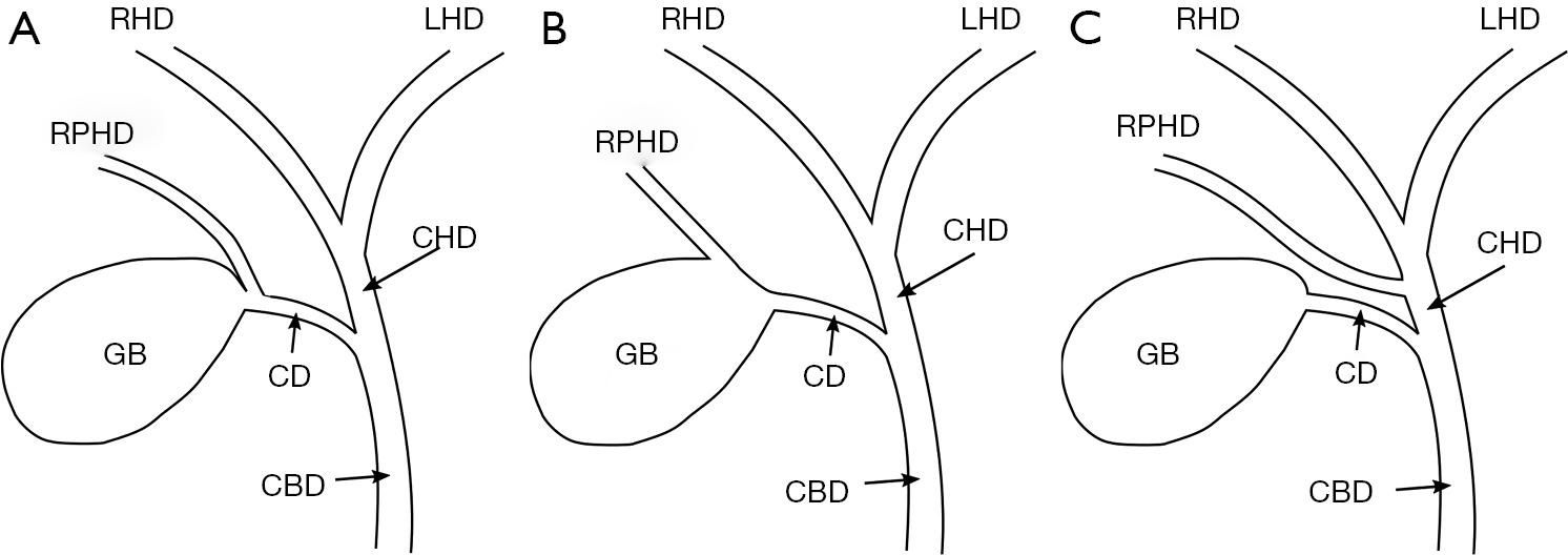 Laparoscopic cholecystectomy: semi-top-down technique - Handzel - Annals of Laparoscopic and Endoscopic Surgery Laparoscopic cholecystectomy: semi-top-down technique - Handzel - Annals of Laparoscopic and Endoscopic Surgery