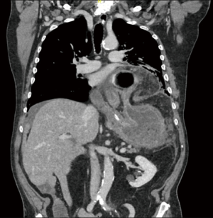 Optimal workup for a hiatal hernia - Laracca - Annals of Laparoscopic ...