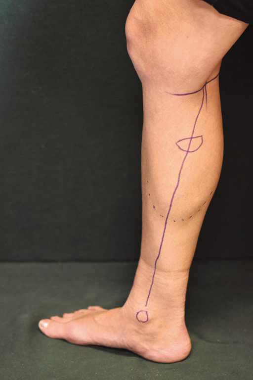 A pragmatic evaluation of the role of the medial sural artery