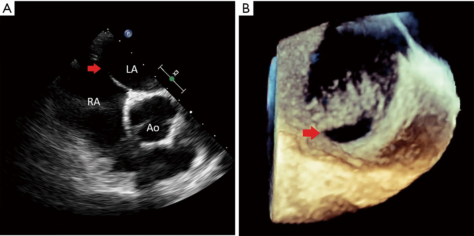 The role of real time 3Dtransesophageal echocardiography for safe and