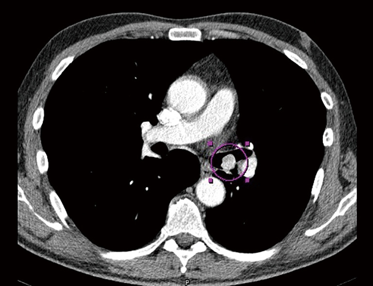 Bronchial carcinoid, unusual manifestation a case report Belicová