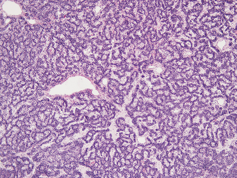 Bronchial carcinoid, unusual manifestation a case report Belicová