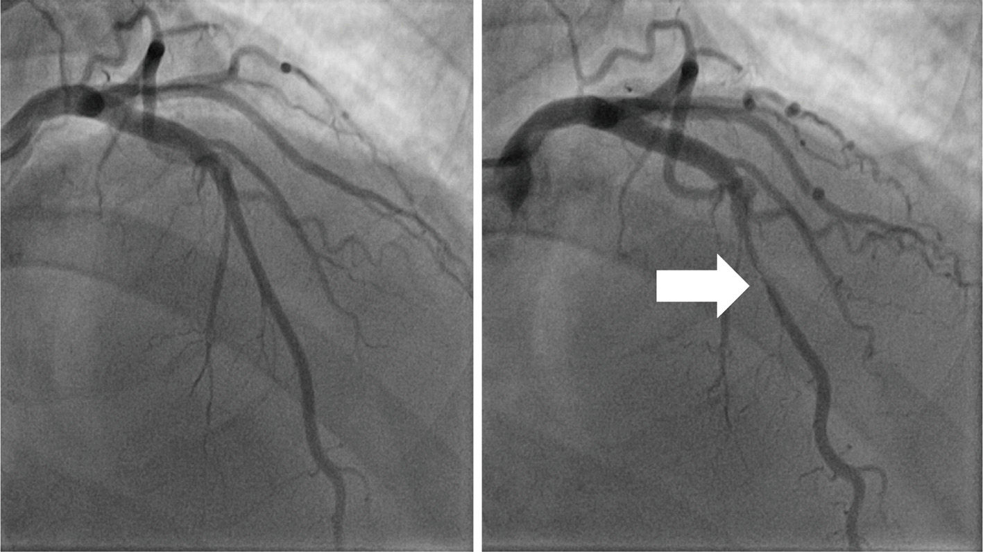 Myocardial bridging mimicking Wellens’ syndrome Pederçole Journal