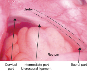 Risk of ureteric injury during ipsilateral uterosacral ligament vault
