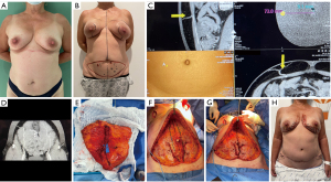The Aesthetics of the Donor Site: DIEP Flap Breast Reconstruction
