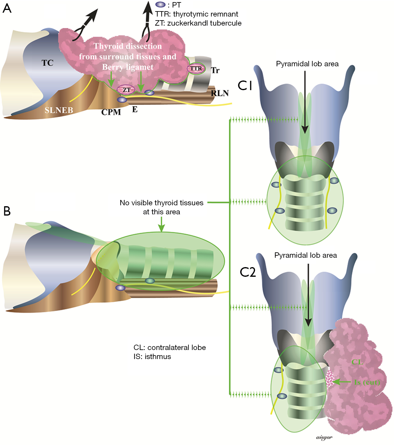 Less Than Total Thyroidectomy For Goiter When And How Makay Gland Surgery Less Than Total Thyroidectomy For Goiter When And How Makay Gland Surgery