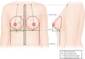 Breast reconstruction - series—Aftercare: MedlinePlus Medical Encyclopedia