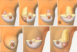Perky Breasts: Surgical and Non-Surgical Solutions - Moein Surgical Arts