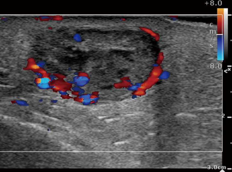 Imaging Of Soft Tissue Sarcomas Patel Chinese Clinical Oncology