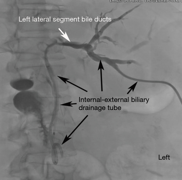 How To Empty A Gallbladder Drainage Best Drain Photos