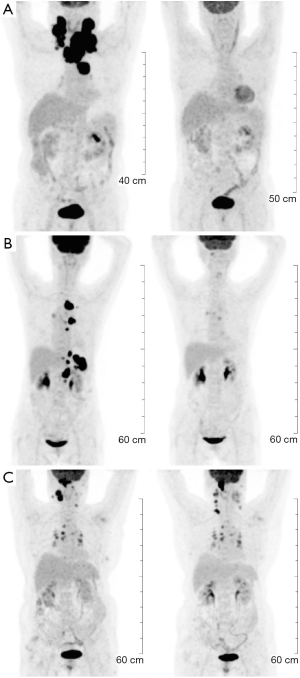 PET/CT: appropriate application in lymphoma - Wang - Chinese Clinical ...