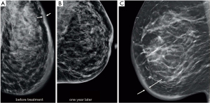 Why diagnosing inflammatory breast cancer is hard and how to overcome the  challenges: a narrative review - Le-Petross - Chinese Clinical Oncology