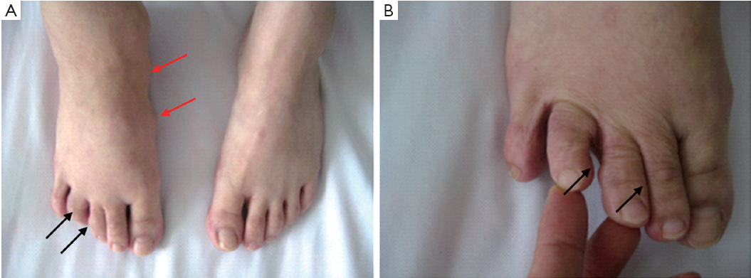 Maffucci Syndrome With Unilateral Limb A Case Report And Review Of The Literature Gao Chinese Journal Of Cancer Research