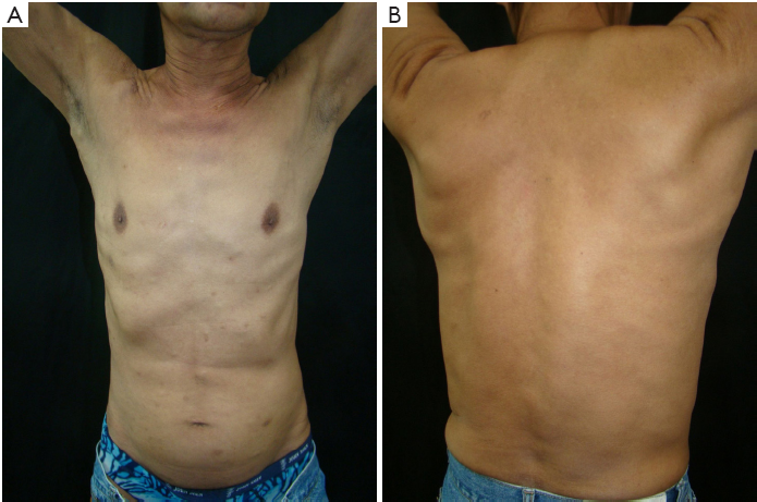 Steatocystoma multiplex as initial impression of non-small cell lung