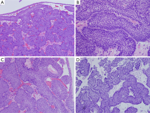 inverted papilloma bladder