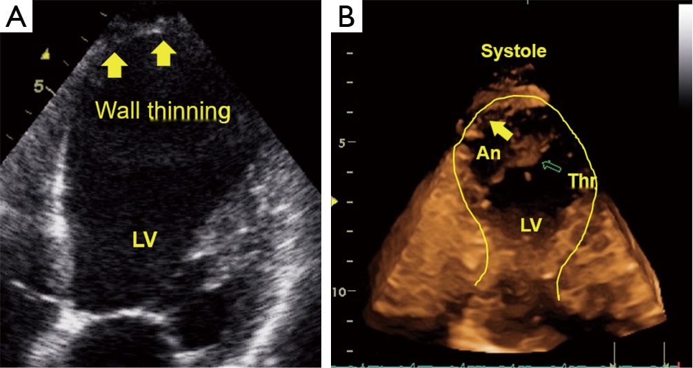 Echocardiographic assessment of myocardial ischemia Leischik Annals