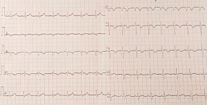 Click on image to zoom case study of patient with pulmonary embolism