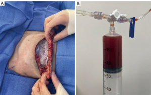 Management of complications following implant-based breast reconstruction:  a narrative review - Meshkin - Annals of Translational Medicine