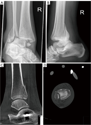 Ilizarov method of fixation for the management of pilon and distal tibial fractures in the compromised diabetic patient: A technique guide.