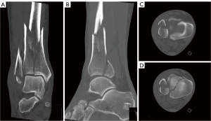 Ilizarov method of fixation for the management of pilon and distal tibial  fractures in the compromised diabetic patient: A technique guide.