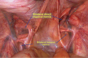 Laparoscopic repair of femoral hernia - Yang - Annals of Translational  Medicine