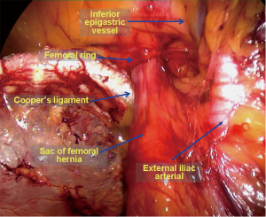 Laparoscopic repair of femoral hernia - Yang - Annals of Translational  Medicine