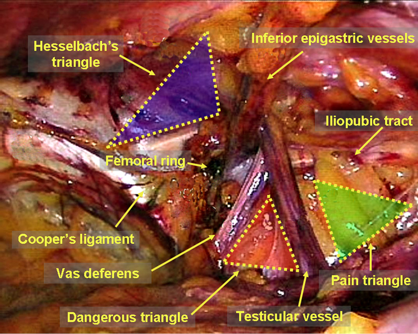 Anatomy essentials for laparoscopic inguinal hernia repair - Yang