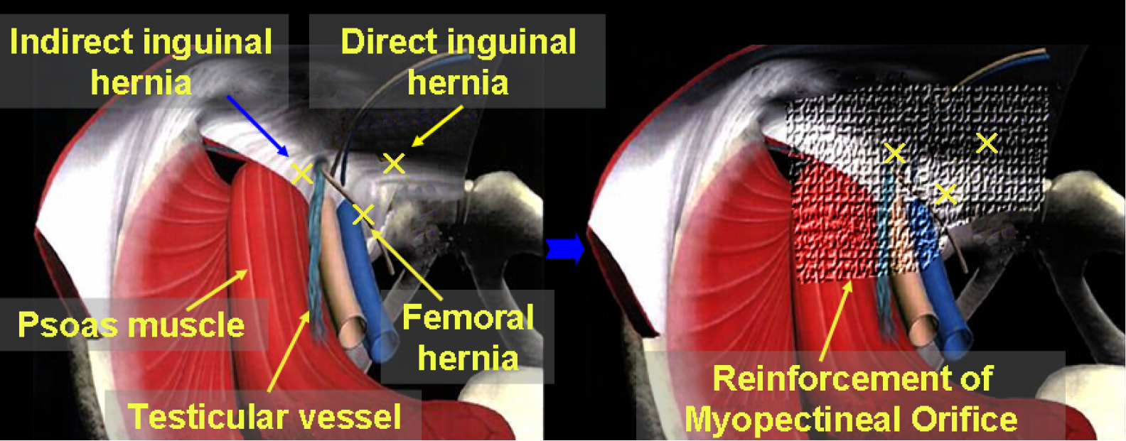 Laparoscopic Inguinal Hernia Anatomy