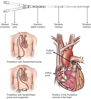 ProtekDuo percutaneous ventricular support system—physiology and clinical  applications - John - Annals of Translational Medicine