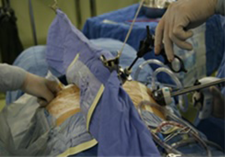 Laparoscopic repair of parastomal hernia Yang Annals of